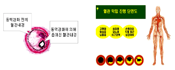 혈관 막힘 진행 단면도