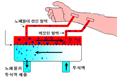 혈액투석 원리 도식
