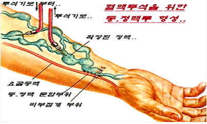 동정맥루 수술 모식도
